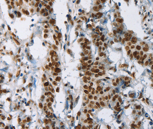 Immunohistochemistry of paraffin-embedded Human gastic cancer using IL17C Polyclonal Antibody at dilution of 1:50