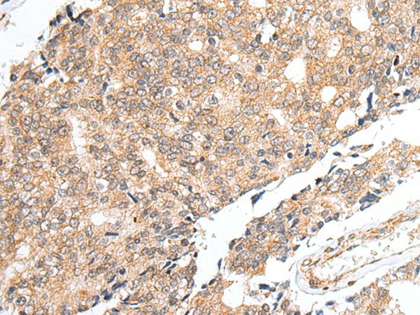 Immunohistochemistry of paraffin-embedded Human prost at e cancer tissue  using PRELID1 Polyclonal Antibody at dilution of 1:40(?200)