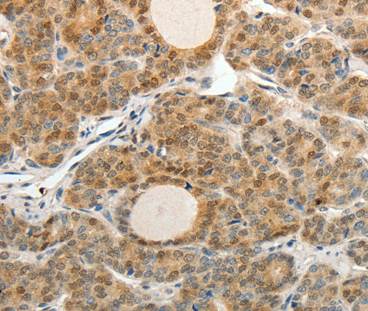 Immunohistochemistry of paraffin-embedded Human thyroid cancer tissue using ASCL1 Polyclonal Antibody at dilution 1:30