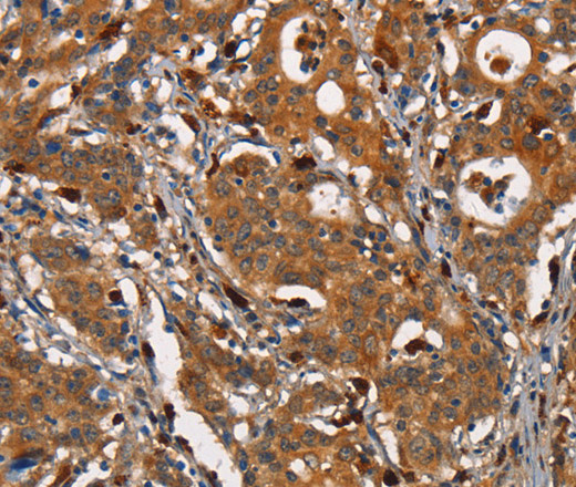 Immunohistochemistry of paraffin-embedded Human gastric cancer tissue using CEACAM3 Polyclonal Antibody at dilution 1:30