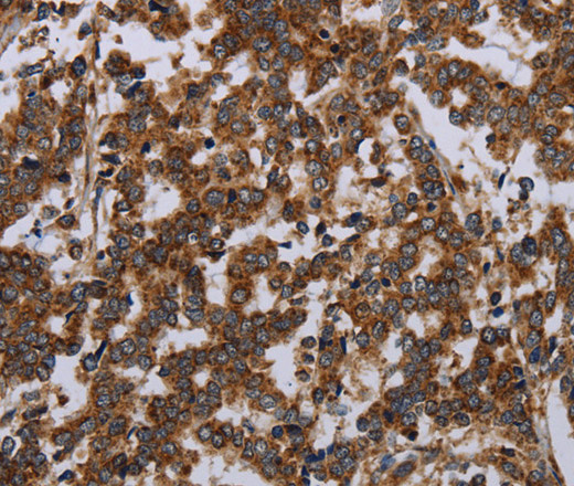 Immunohistochemistry of paraffin-embedded Human liver cancer using GDF2 Polyclonal Antibody at dilution of 1:40