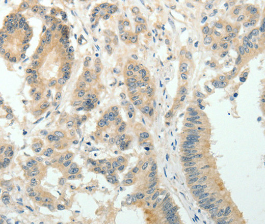 Immunohistochemistry of paraffin-embedded Human colon cancer using SIRT3 Polyclonal Antibody at dilution of 1:30