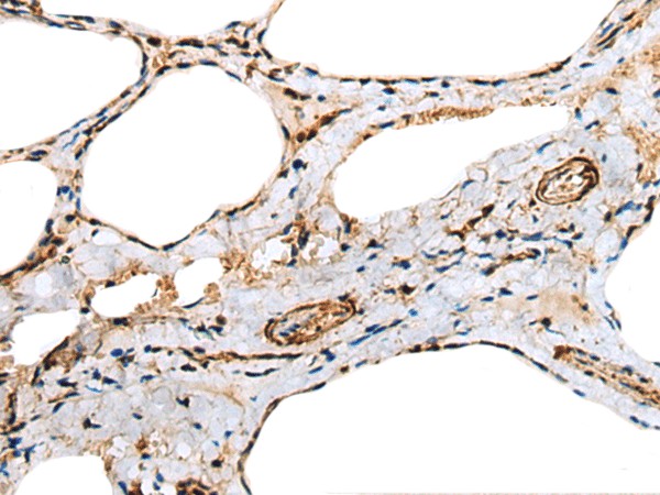 Immunohistochemistry of paraffin-embedded Human thyroid cancer tissue  using TNNC1 Polyclonal Antibody at dilution of 1:25(?200)