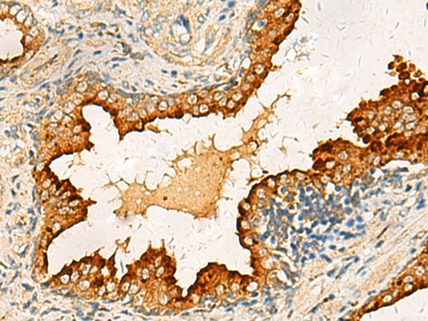 Immunohistochemistry of paraffin-embedded Human prost ate cancer tissue  using PDCL Polyclonal Antibody at dilution of 1:40(?200)