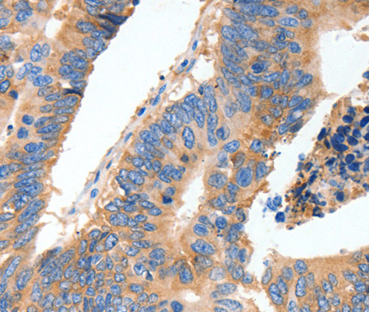 Immunohistochemistry of paraffin-embedded Human colon cancer tissue using MUC6 Polyclonal Antibody at dilution 1:40