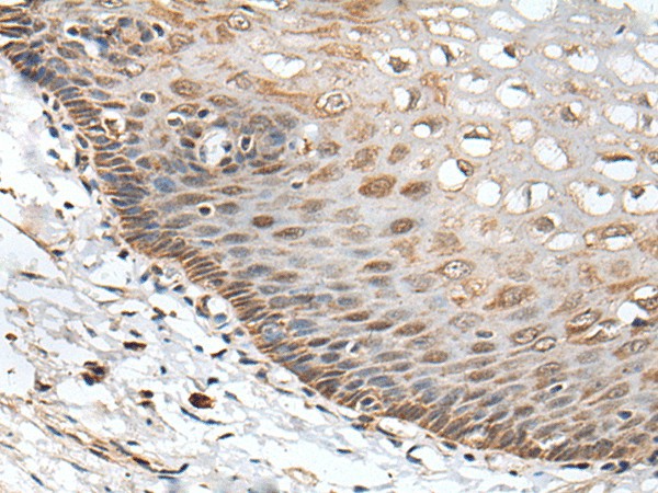 Immunohistochemistry of paraffin-embedded Human esophagus cancer tissue  using CHRNA5 Polyclonal Antibody at dilution of 1:50(?200)