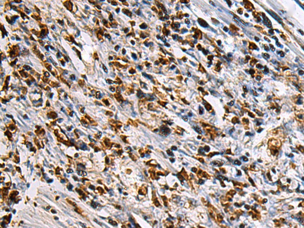 Immunohistochemistry of paraffin-embedded Human gastric cancer tissue  using SAV1 Polyclonal Antibody at dilution of 1:90(?200)