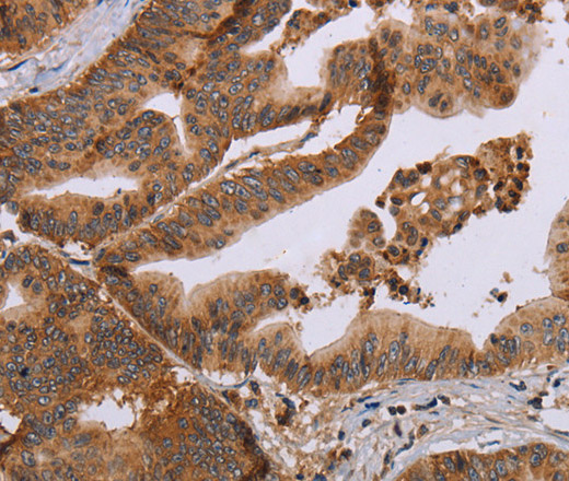 Immunohistochemistry of paraffin-embedded Human gastric cancer tissue using MFAP5 Polyclonal Antibody at dilution 1:40