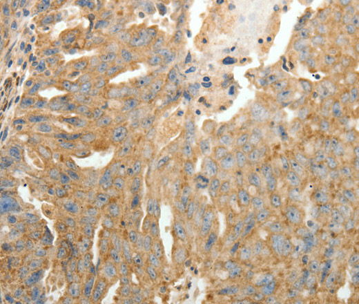 Immunohistochemistry of paraffin-embedded Human ovarian cancer tissue using SFTPD Polyclonal Antibody at dilution 1:30