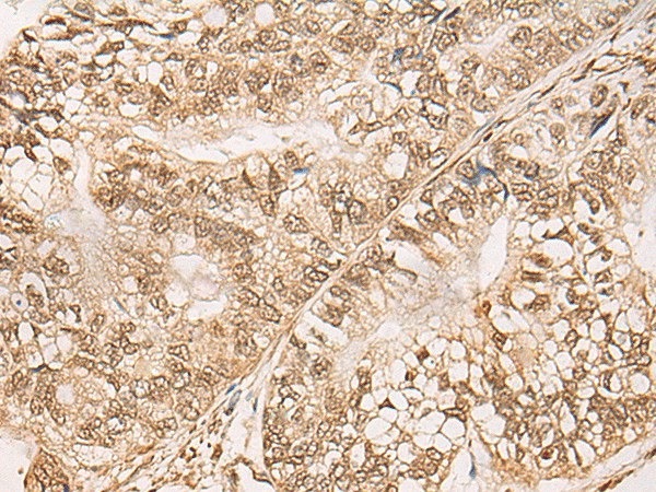 Immunohistochemistry of paraffin-embedded Human gastric cancer tissue  using WEE1 Polyclonal Antibody at dilution of 1:35(?200)