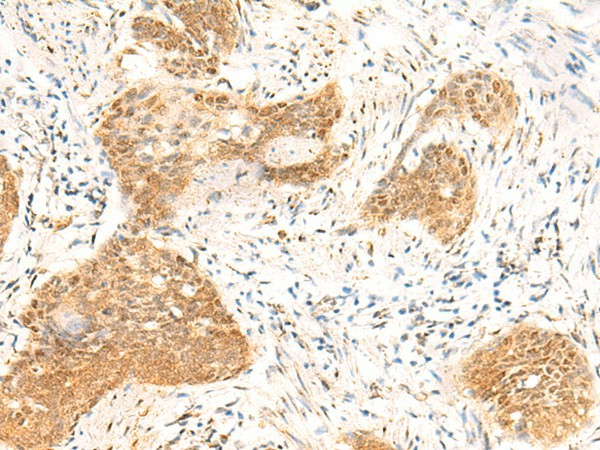 Immunohistochemistry of paraffin-embedded Human esophagus cancer tissue  using TBPL1 Polyclonal Antibody at dilution of 1:50(?200)