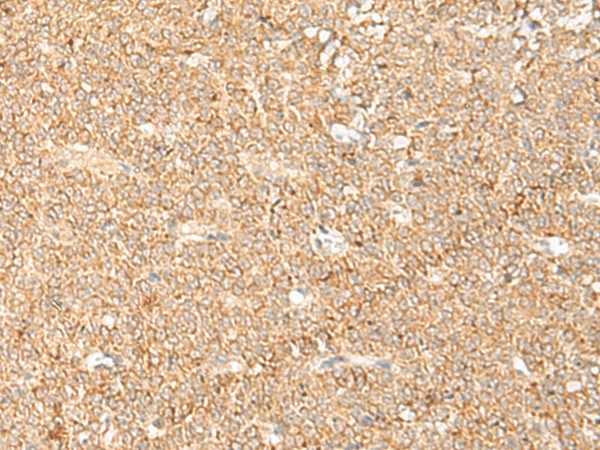 Immunohistochemistry of paraffin-embedded Human ovarian cancer tissue  using LGALSL Polyclonal Antibody at dilution of 1:70(?200)