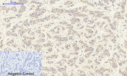 Immunohistochemistry of paraffin-embedded Human liver cancer tissue using TGFB1 Polyclonal Antibody at dilution of 1:200.