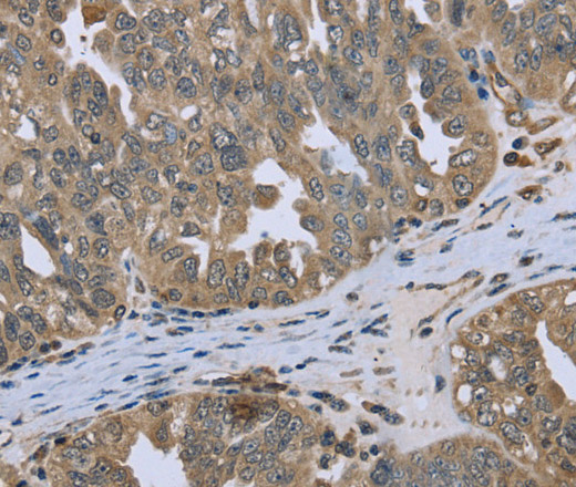 Immunohistochemistry of paraffin-embedded Human ovarian cancer tissue using DCTN4 Polyclonal Antibody at dilution 1:50