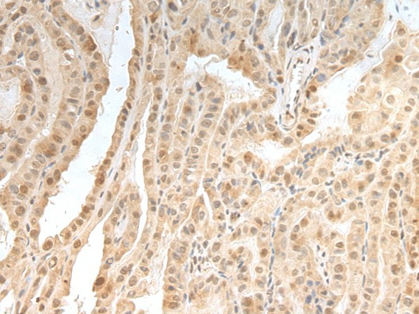 Immunohistochemistry of paraffin-embedded Human thyroid cancer tissue  using ZNF24 Polyclonal Antibody at dilution of 1:35(?200)