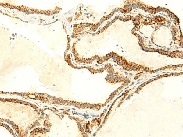 Immunohistochemistry of paraffin-embedded Human thyroid cancer tissue  using NAPRT Polyclonal Antibody at dilution of 1:50(?200)