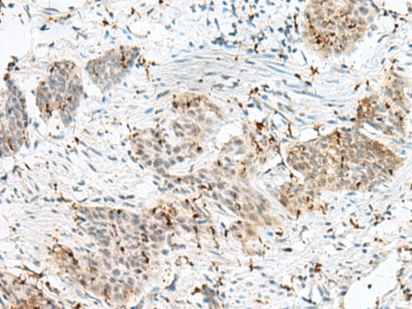 Immunohistochemistry of paraffin-embedded Human esophagus cancer tissue  using PLCL2 Polyclonal Antibody at dilution of 1:50(?200)