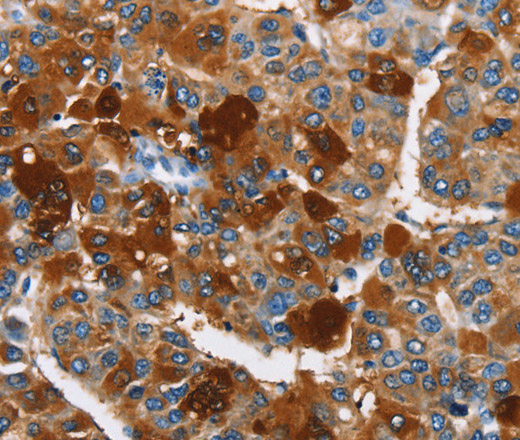 Immunohistochemistry of paraffin-embedded Human liver cancer using ARMCX2 Polyclonal Antibody at dilution of 1:40