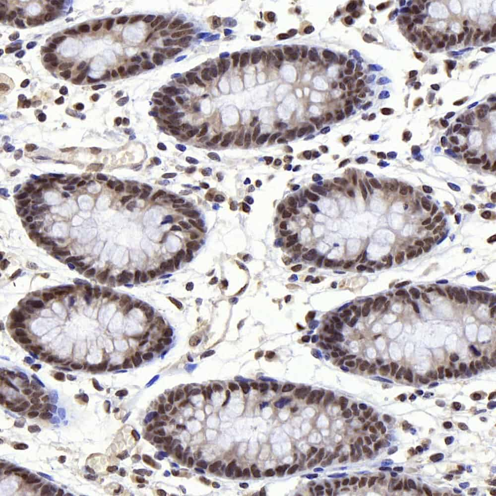 Immunohistochemistry analysis of paraffin-embedded human colon  using p27 Polyclonal Antibody at dilution of 1:400.