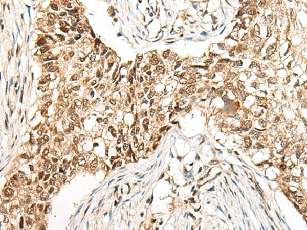 Immunohistochemistry of paraffin-embedded Human lung cancer tissue  using CCDC181 Polyclonal Antibody at dilution of 1:50(?200)