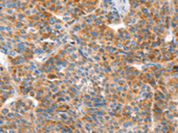 Immunohistochemistry of paraffin-embedded Human liver cancer tissue  using VTN Polyclonal Antibody at dilution of 1:100(?200)