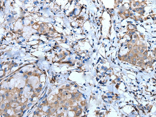 Immunohistochemistry of paraffin-embedded Human breast cancer tissue  using F3 Polyclonal Antibody at dilution of 1:60(?200)