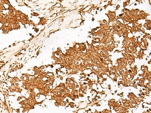 Immunohistochemistry of paraffin-embedded Human lung cancer tissue  using HUS1 Polyclonal Antibody at dilution of 1:65(?200)