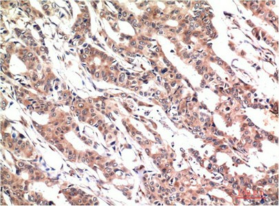 Immunohistochemistry of paraffin-embedded Human colon carcinoma tissue using Phospho-STAT3 (Tyr705) Monoclonal Antibody at dilution of 1:200.