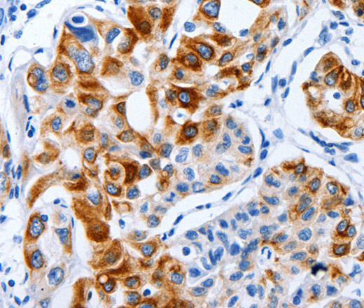 Immunohistochemistry of paraffin-embedded Human lung cancer using BPIFB3 Polyclonal Antibody at dilution of 1:120