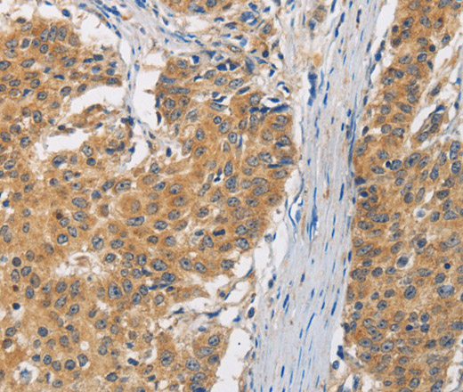 Immunohistochemistry of paraffin-embedded Human gasrtic cancer tissue using FASTK Polyclonal Antibody at dilution 1:30