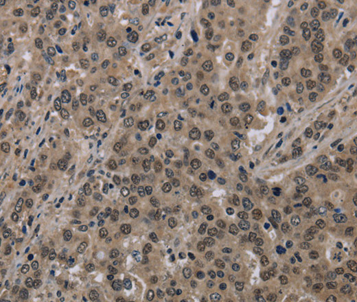 Immunohistochemistry of paraffin-embedded Human liver cancer using HIST1H2AH Polyclonal Antibody at dilution of 1:40