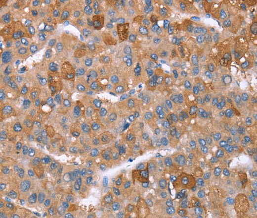 Immunohistochemistry of paraffin-embedded Human liver cancer tissue using GPC6 Polyclonal Antibody at dilution 1:40