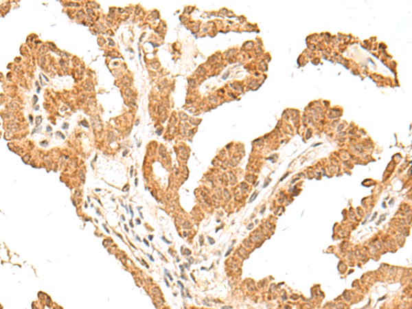 Immunohistochemistry of paraffin-embedded Human thyroid cancer tissue  using FANCB Polyclonal Antibody at dilution of 1:60(?200)