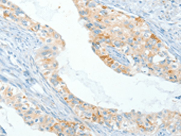 Immunohistochemistry of paraffin-embedded Human cervical cancer tissue  using APOL2 Polyclonal Antibody at dilution of 1:80(?200)