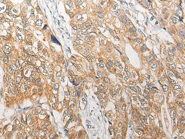 Immunohistochemistry of paraffin-embedded Human gastric cancer tissue  using RGN Polyclonal Antibody at dilution of 1:25(?200)