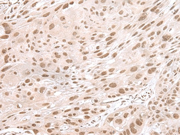 Immunohistochemistry of paraffin-embedded Human esophagus cancer tissue  using MAGOHB Polyclonal Antibody at dilution of 1:60(?200)