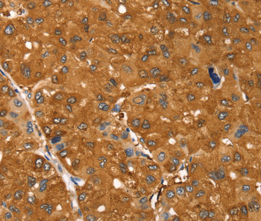 Immunohistochemistry of paraffin-embedded Human ovarian cancer tissue using SSTR3 Polyclonal Antibody at dilution 1:30