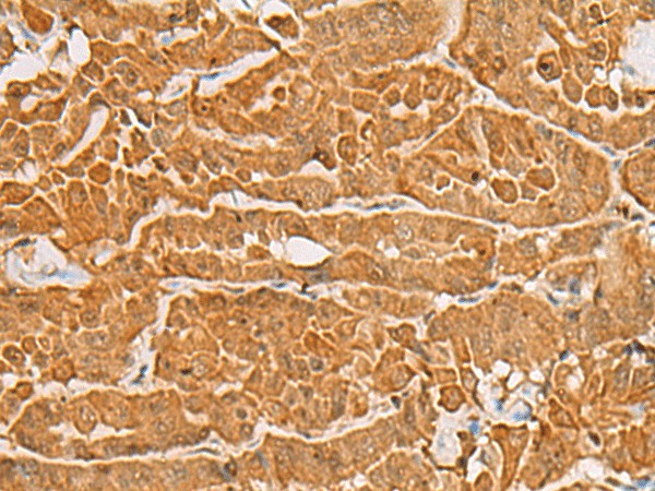 Immunohistochemistry of paraffin-embedded Human thyroid cancer tissue  using MAPK14 Polyclonal Antibody at dilution of 1:60(?200)