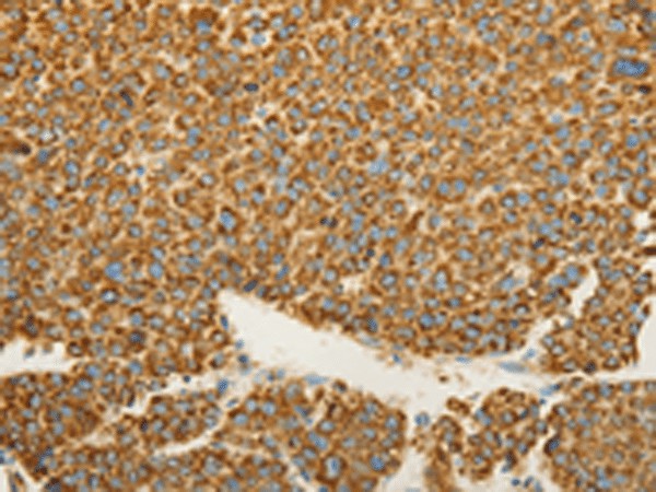 Immunohistochemistry of paraffin-embedded Human liver cancer tissue  using VDAC2 Polyclonal Antibody at dilution of 1:25(?200)