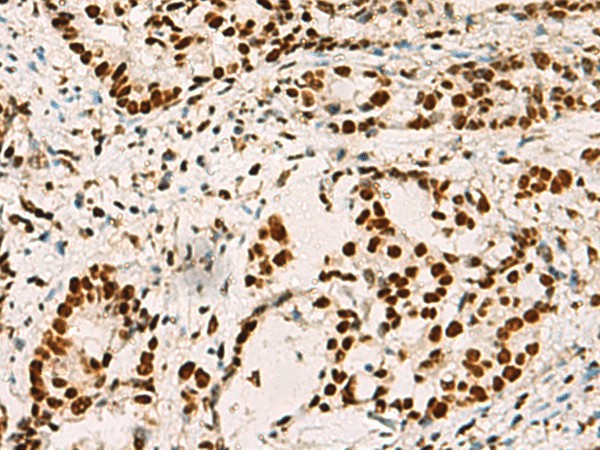 Immunohistochemistry of paraffin-embedded Human cervical cancer tissue  using ELF5 Polyclonal Antibody at dilution of 1:70(?200)