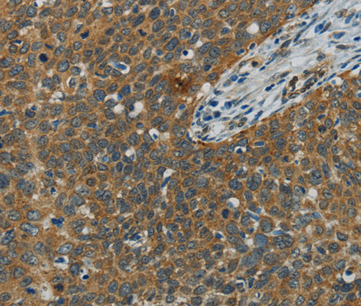 Immunohistochemistry of paraffin-embedded Human cervical cancer using E2F6 Polyclonal Antibody at dilution of 1:60