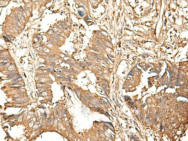 Immunohistochemistry of paraffin-embedded Human colorectal cancer tissue  using GALR2 Polyclonal Antibody at dilution of 1:25(?200)