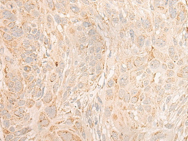 Immunohistochemistry of paraffin-embedded Human esophagus cancer tissue  using COX6C Polyclonal Antibody at dilution of 1:25(?200)