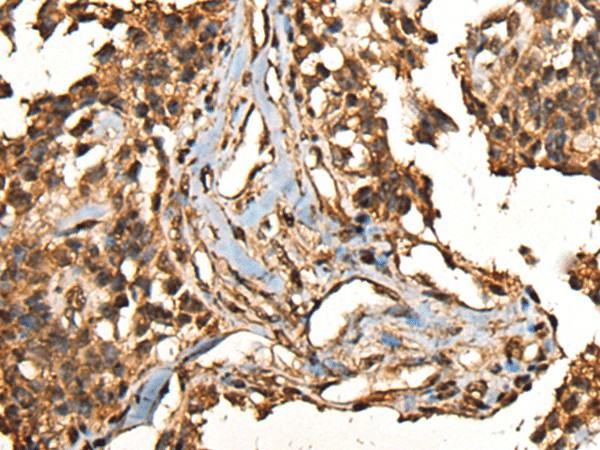 Immunohistochemistry of paraffin-embedded Human ovarian cancer tissue  using CAMKK1 Polyclonal Antibody at dilution of 1:35(?200)