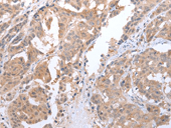 Immunohistochemistry of paraffin-embedded Human breast cancer tissue  using ATG16L1 Polyclonal Antibody at dilution of 1:45(?200)