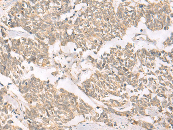 Immunohistochemistry of paraffin-embedded Human lung cancer tissue  using RRP8 Polyclonal Antibody at dilution of 1:50(?200)