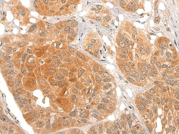 Immunohistochemistry of paraffin-embedded Human esophagus cancer tissue  using NOG Polyclonal Antibody at dilution of 1:40(?200)