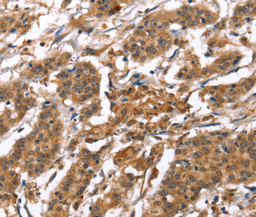 Immunohistochemistry of paraffin-embedded Human gastric cancer tissue using BNIP2 Polyclonal Antibody at dilution 1:50