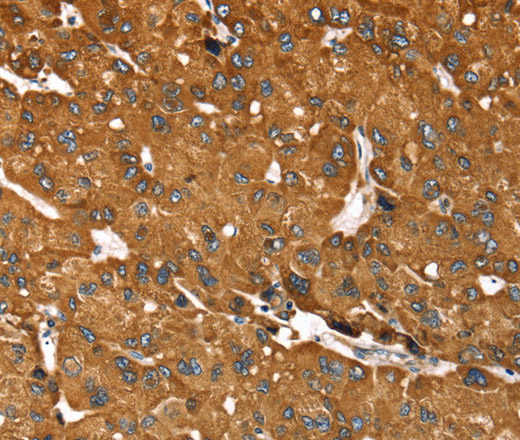 Immunohistochemistry of paraffin-embedded Human liver cancer tissue using RASSF3 Polyclonal Antibody at dilution 1:35