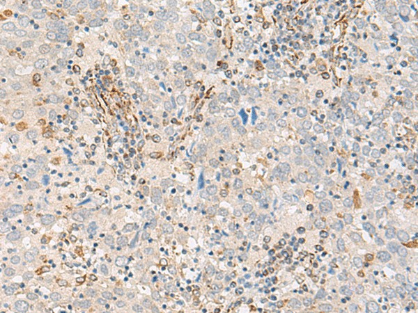 Immunohistochemistry of paraffin-embedded Human cervical cancer tissue  using FECH Polyclonal Antibody at dilution of 1:55(?200)